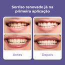 Violux - Fita de Clareamento Roxa Que Elimina o Amarelado e Clareia os Dentes Desde a Primeira Sessão (Oferta Exclusiva)